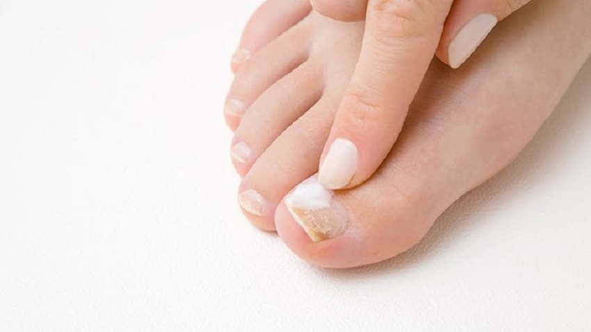 Causes And Solutions To Toenail Fungus Treatments Of 2022 Creative Jasmin